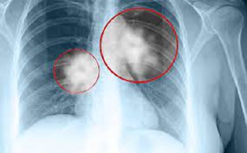 chẩn đoán ung thư phổi