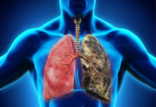 Nguyên nhân ung thư phổi