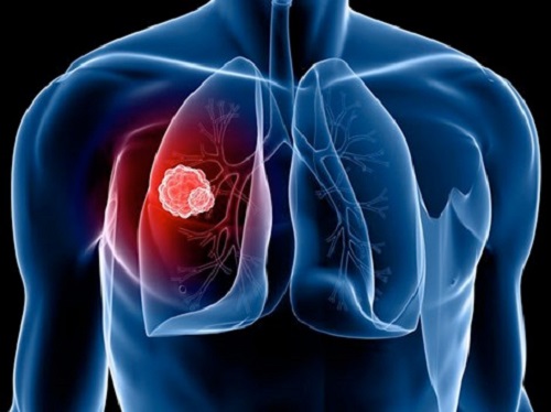 Tỷ lệ sống sót của ung thư phổi không phải tế bào nhỏ giai doạn 1A