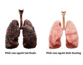 Điều gì gây ra ung thư phổi ở những người không hút thuốc