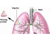 Hạch bạch huyết trong ung thư phổi