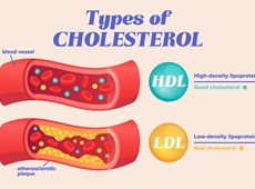 Mức cholesterol LDL tối ưu cho bệnh nhân mắc các bệnh tim mạch là bao nhiêu?