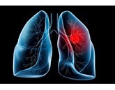 Tỷ lệ sống sót của ung thư phổi không phải tế bào nhỏ giai doạn 2A