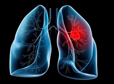 Tỷ lệ sống sót của ung thư phổi không phải tế bào nhỏ giai doạn 2A